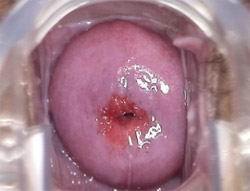 轻度宫颈糜烂图